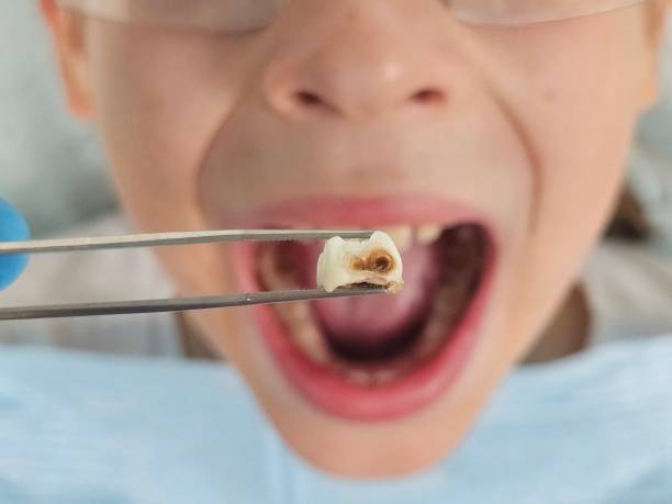 Best Emergency Dentist for Knocked-Out Tooth in Lubbock, TX